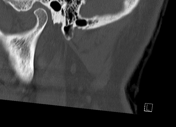 Chiari I malformation with a symptomatic syrinx of the posterolateral medulla oblongata (Radiopaedia 42573-45707 A 56).jpg