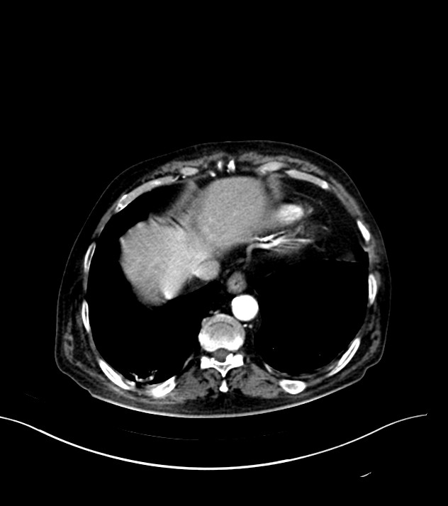 Cholangiocarcinoma with cerebral metastases (Radiopaedia 83519-98629 B 7).jpg