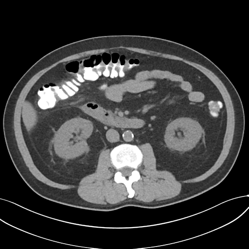 File:Cholecystitis with focal perforation and hepatic abscess (Radiopaedia 37189-38945 Axial non-contrast 40).png