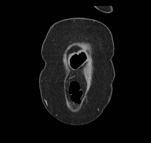 Cholecystoduodenal fistula (Radiopaedia 48959-54022 B 9).jpg