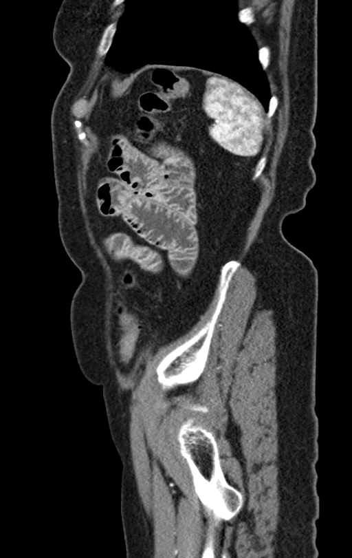 Cholecystoduodenal fistula due to calculous cholecystitis with gallstone migration (Radiopaedia 86875-103077 C 9).jpg