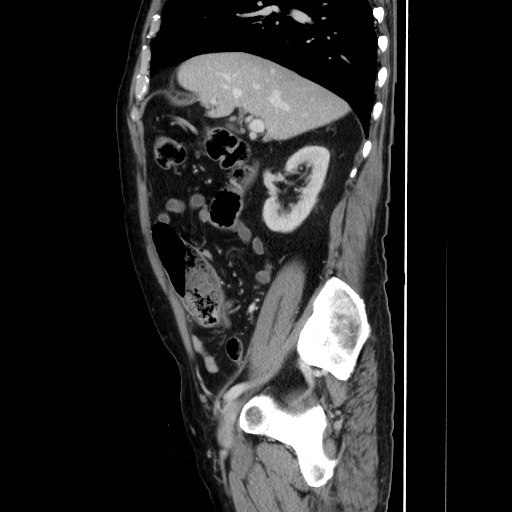 Choledocholiathiasis with normal caliber common bile duct (Radiopaedia 75368-86632 D 60).jpg