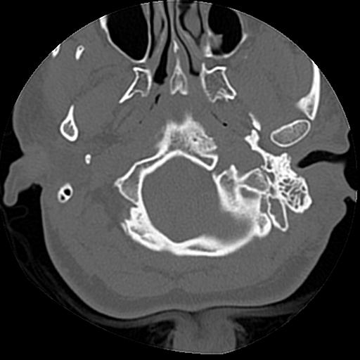 Cholesteatoma (Radiopaedia 84960-100474 Axial bone window 59).jpg