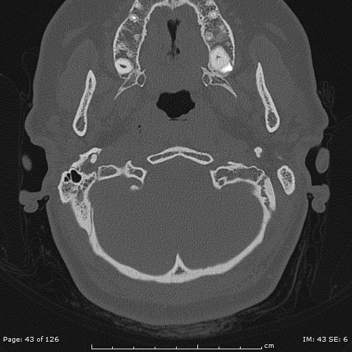 Cholesteatoma - external auditory canal (Radiopaedia 88452-105096 Axial bone window 6).jpg