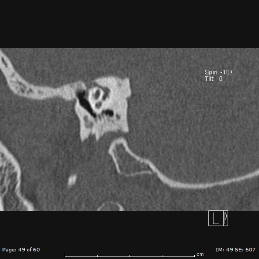 Cholesteatoma - external auditory canal (Radiopaedia 88452-105096 Sagittal bone window 49).jpg