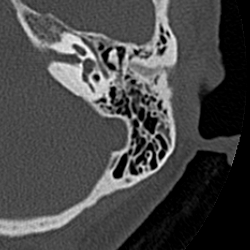 File:Cholesteatoma of the external ear (Radiopaedia 16540-16225 Axial bone window 19).jpg