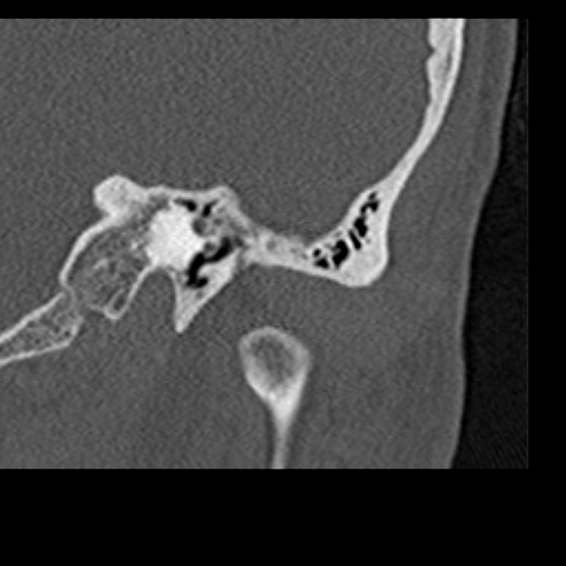 File:Cholesteatoma of the external ear (Radiopaedia 16540-16225 Coronal bone window 5).jpg