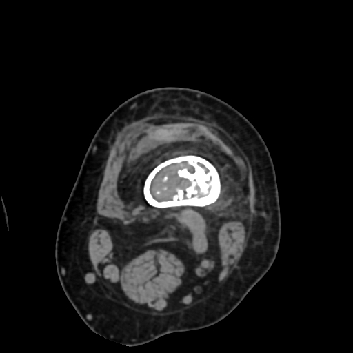 Chondrosarcoma - femur (Radiopaedia 64187-72954 Axial non-contrast 24).jpg