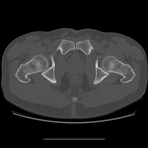 File:Chondrosarcoma of iliac wing (Radiopaedia 63861-72599 Axial bone window 111).jpg