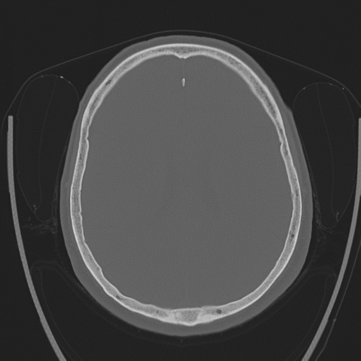 Chondrosarcoma of skull base- grade II (Radiopaedia 40948-43653 Axial bone window 31).png