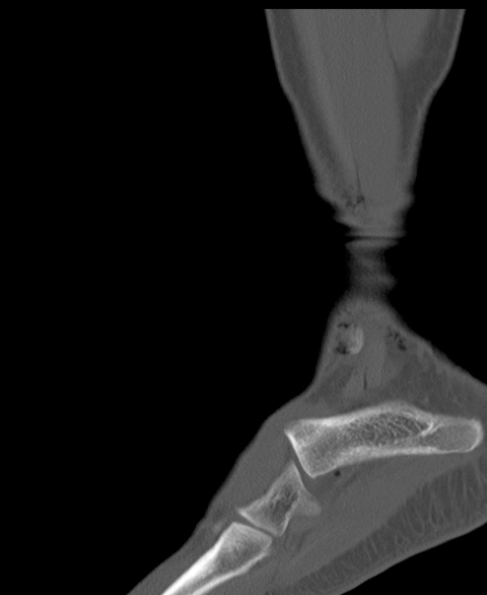 Chopart fracture (Radiopaedia 35347-36851 Sagittal bone window 53).jpg