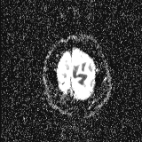 Choroid plexus xanthogranuloma - unilateral (Radiopaedia 85632-101393 Axial ADC 60).jpg