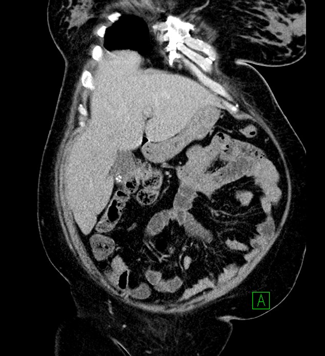 Chromophobe renal cell carcinoma (Radiopaedia 84239-99519 F 26).jpg