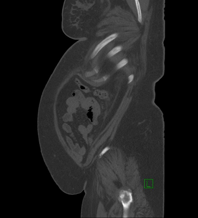 Chromophobe renal cell carcinoma (Radiopaedia 84239-99519 Sagittal bone window 11).jpg