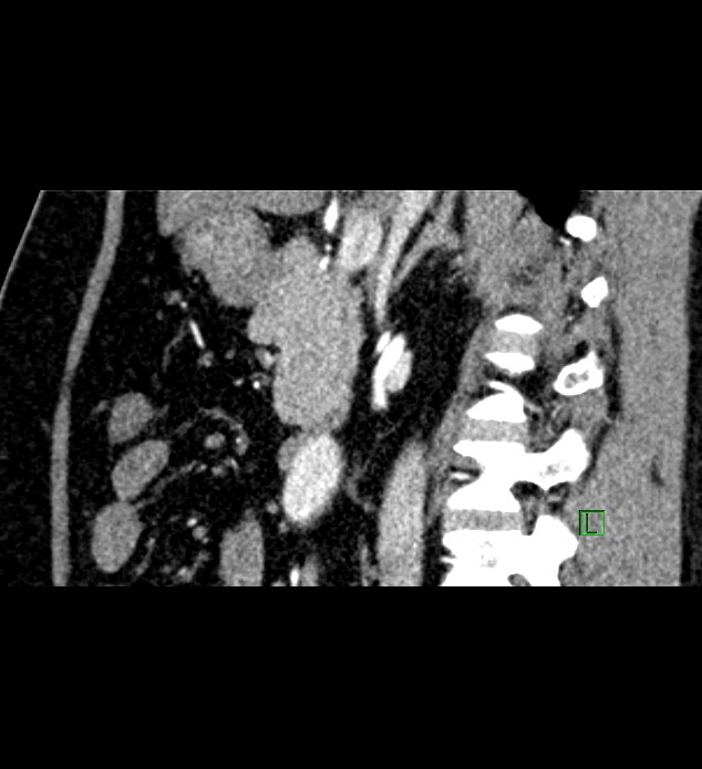 Chromophobe renal cell carcinoma (Radiopaedia 84286-99573 F 98).jpg