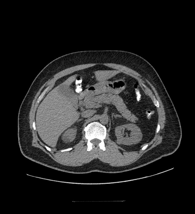 Chromophobe renal cell carcinoma (Radiopaedia 84337-99644 Axial non-contrast 31).jpg