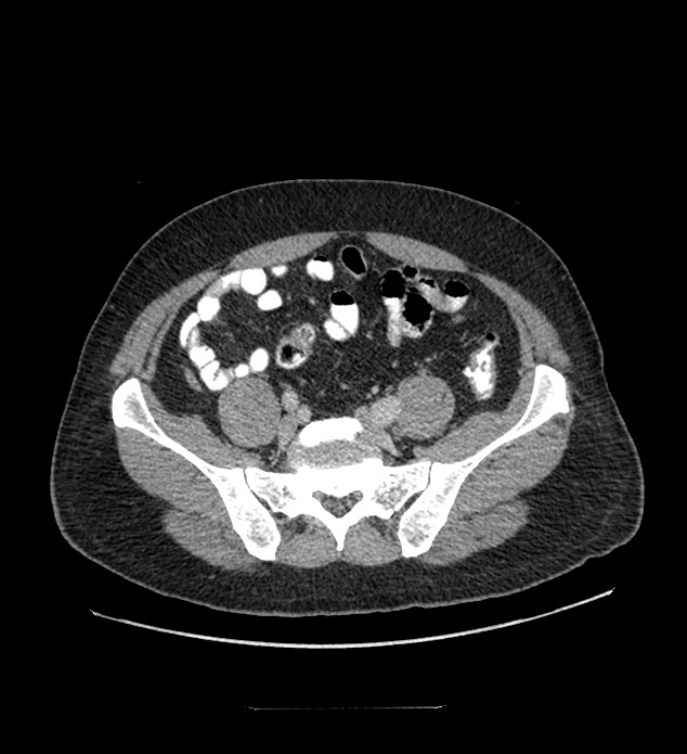 Chromophobe renal cell carcinoma (Radiopaedia 84337-99644 C 98).jpg