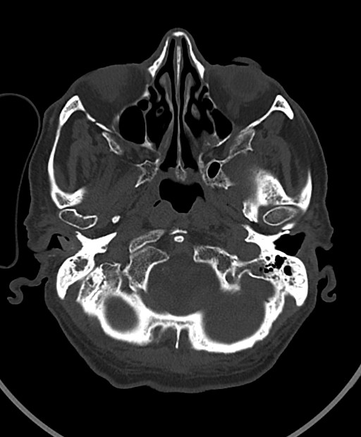 Chronic bilateral subdural hygroma (Radiopaedia 85801-101623 Axial bone window 102).jpg