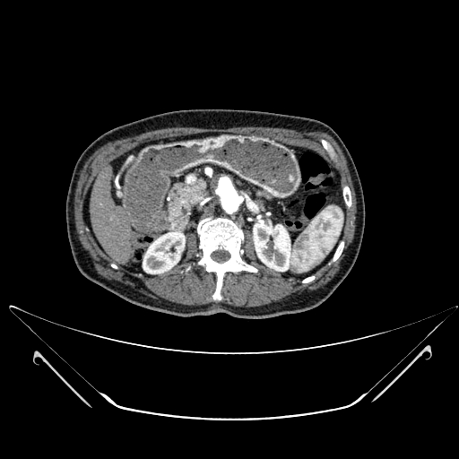 Chronic contained rupture of abdominal aortic aneurysm with extensive erosion of the vertebral bodies (Radiopaedia 55450-61901 A 17).jpg