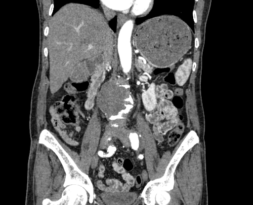 Chronic contained rupture of abdominal aortic aneurysm with extensive erosion of the vertebral bodies (Radiopaedia 55450-61901 D 38).jpg