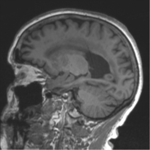 Chronic hypertensive encephalopathy (Radiopaedia 39993-42482 Sagittal T1 59).png