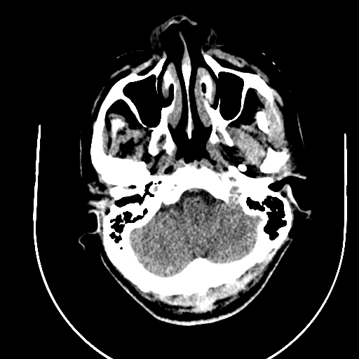 Chronic invasive fungal sinusitis (Radiopaedia 91563-109286 Axial non-contrast 7).jpg