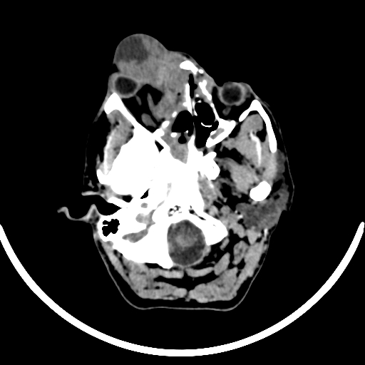 File:Chronic invasive fungal sinusitis with intraorbital and intracranial extension (Radiopaedia 56387-63046 Axial non-contrast 100).jpg