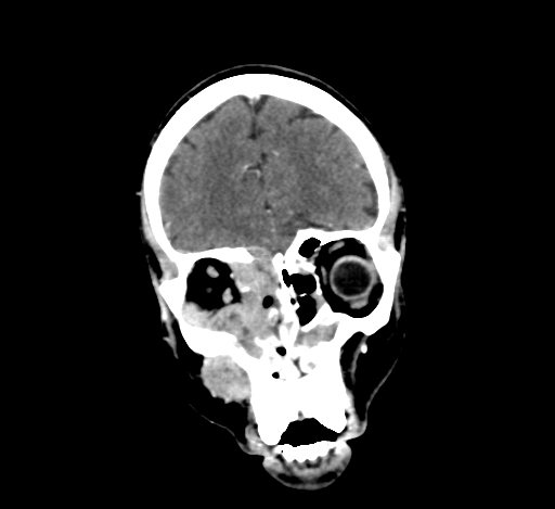 Chronic invasive fungal sinusitis with intraorbital and intracranial extension (Radiopaedia 56387-63046 C 90).jpg