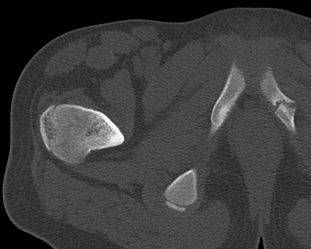 File:Chronic ostemyelitis of the femur with long sinus tract (Radiopaedia 74947-85982 Axial bone window 14).jpg