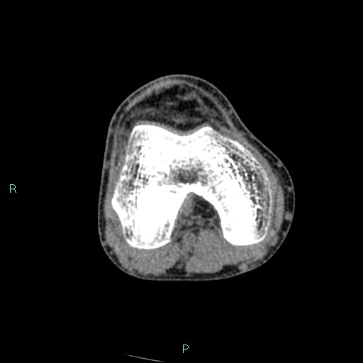 Chronic osteomyelitis (with Brodie abscess) (Radiopaedia 76405-88111 A 128).jpg