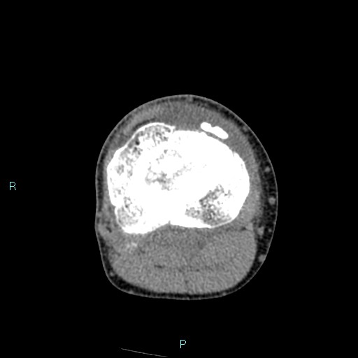 Chronic osteomyelitis (with Brodie abscess) (Radiopaedia 76405-88111 A 94).jpg