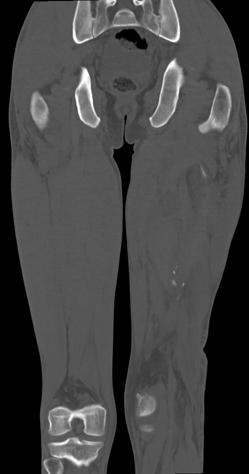 Chronic osteomyelitis (with sequestrum) (Radiopaedia 74813-85822 Coronal non-contrast 38).jpg