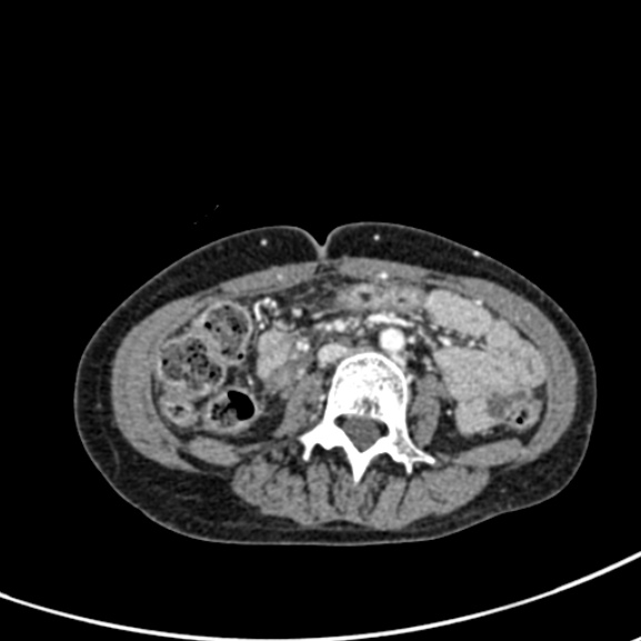 File:Chronic pancreatitis (Radiopaedia 55405-61846 A 56).jpg