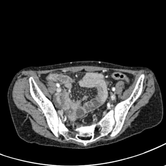File:Chronic pancreatitis (Radiopaedia 55405-61846 A 85).jpg