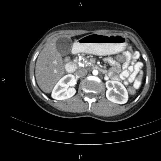 Chronic pancreatitis (Radiopaedia 64576-73450 B 58).jpg