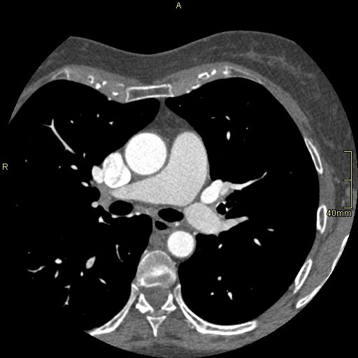 Chronic pulmonary embolism (Radiopaedia 73073-85094 Axial C+ CTPA 58).jpg