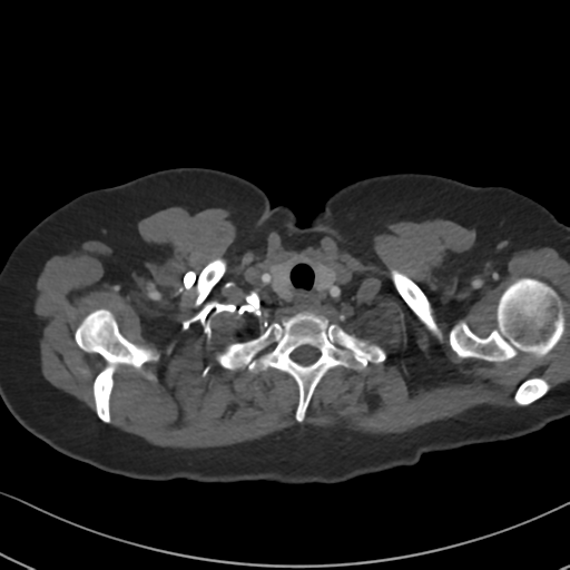 File:Chronic pulmonary embolus (Radiopaedia 39129-41341 Axial C+ CTPA 9).png