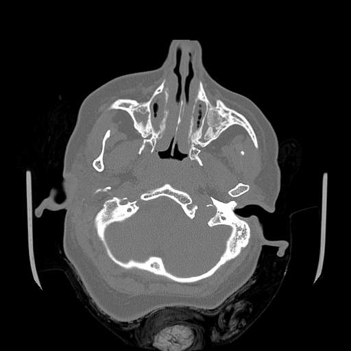 File:Chronic sinusitis with intra-sinus calcification (Radiopaedia 63919-72668 Axial bone window 59).jpg