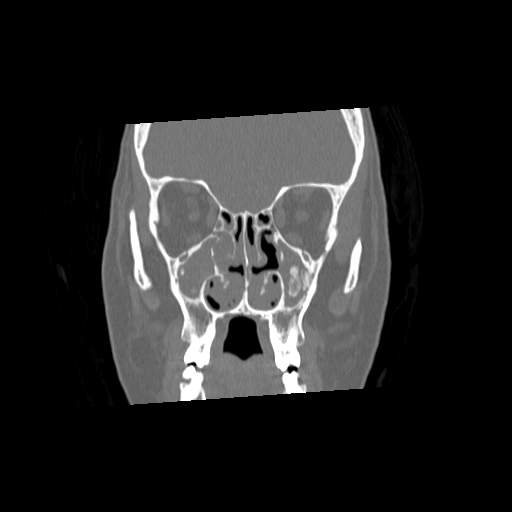 File:Chronic sinusitis with intra-sinus calcification (Radiopaedia 63919-72668 Coronal bone window 12).jpg