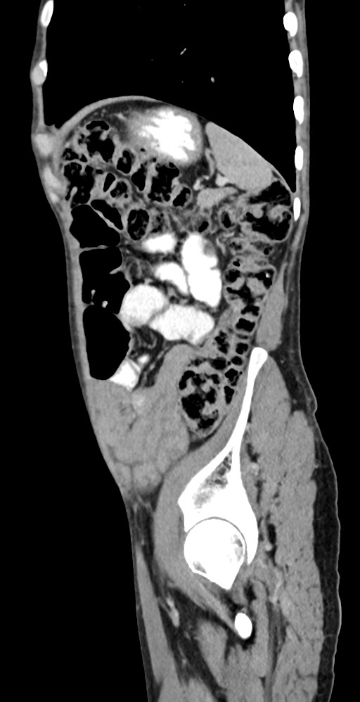 Chronic small bowel volvulus (Radiopaedia 75224-86322 C 36).jpg