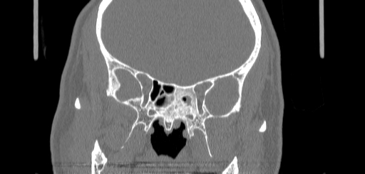Chronic sphenoidal sinusitis (Radiopaedia 62030-70122 Coronal bone window 103).jpg