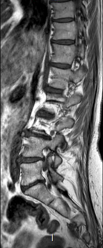 File:Chronic spinal hematoma with cauda equina syndrome (Radiopaedia 75745-87090 Sagittal T1 11).png