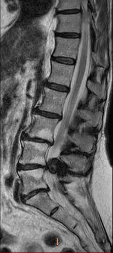 File:Chronic spinal hematoma with cauda equina syndrome (Radiopaedia 75745-87090 Sagittal T2 7).png