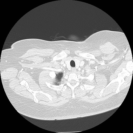 Cicatrisation collapse (Radiopaedia 17405-17089 lung window 9).jpg