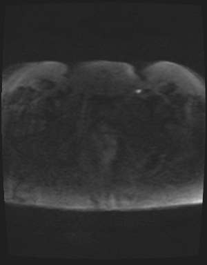Class II Mullerian duct anomaly- unicornuate uterus with rudimentary horn and non-communicating cavity (Radiopaedia 39441-41755 Axial DWI 91).jpg