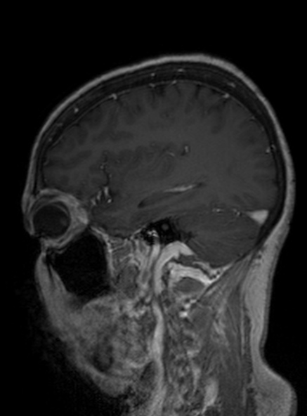 Clival meningioma (Radiopaedia 53278-59248 Sagittal T1 C+ 194).jpg