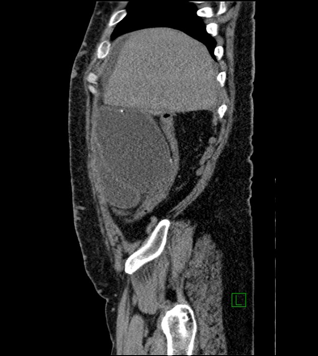 Closed-loop small bowel obstruction-internal hernia (Radiopaedia 78439-91096 C 118).jpg