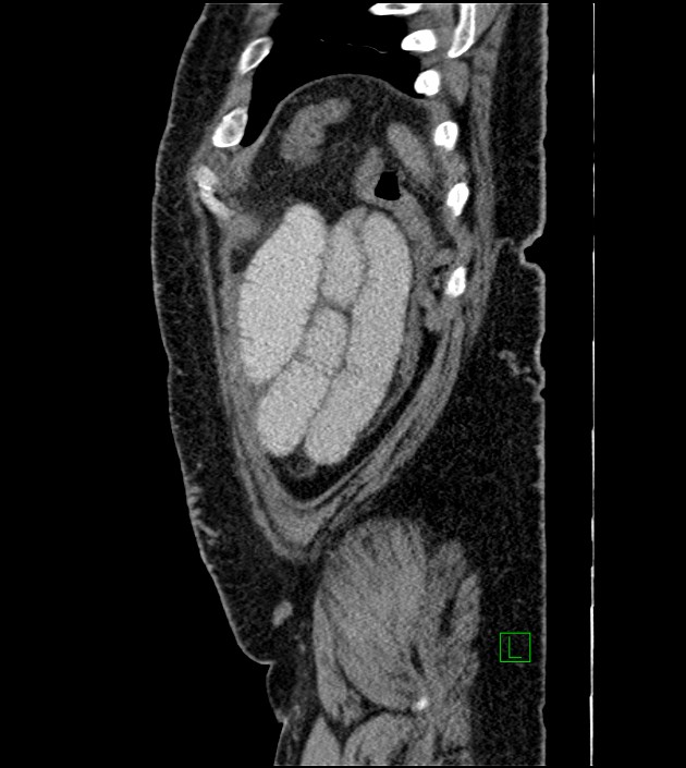 Closed-loop small bowel obstruction-internal hernia (Radiopaedia 78439-91096 C 26).jpg