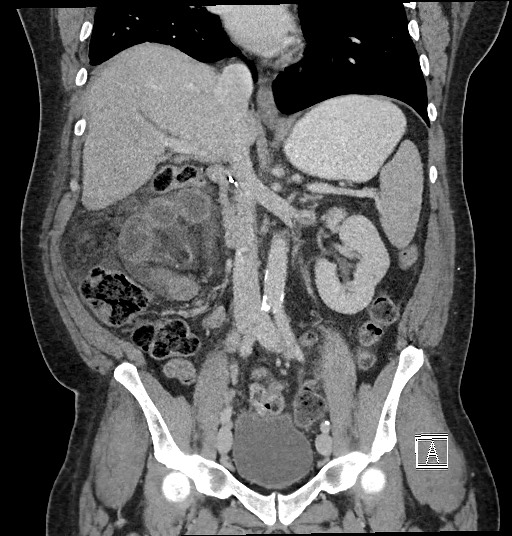 File:Closed loop obstruction - internal hernia into nephrectomy bed (Radiopaedia 59867-67320 B 72).jpg