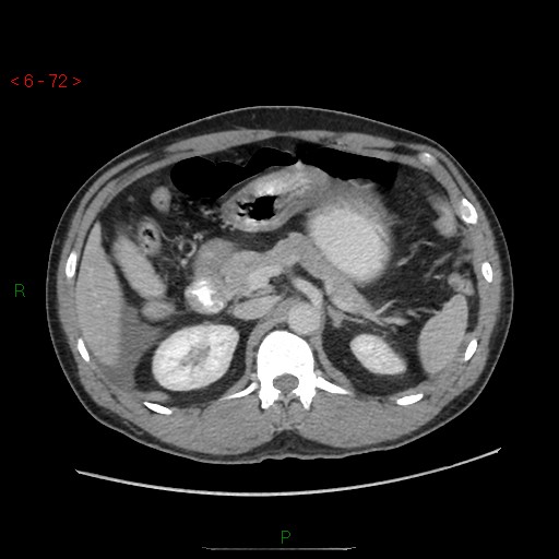 File:Closed loop obstruction and appendicular stump mucocele (Radiopaedia 54014-60163 A 36).jpg